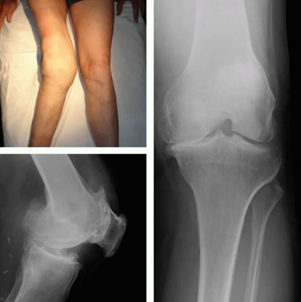 Мыщелка ноги. Двусторонний деформирующий гонартроз. Деформирующий гонартроз рентген. Деформирующий гонартроз коленного сустава 2-3 степени. Рентген коленного сустава деформирующий гонартроз.