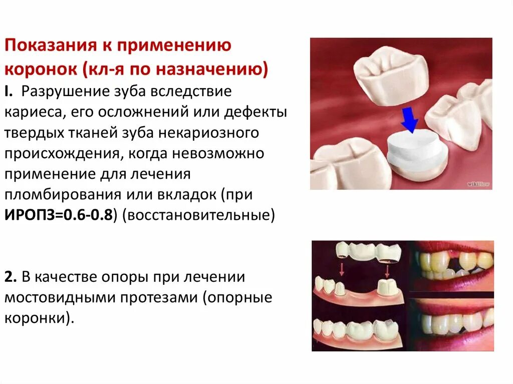 Почему ставят коронки. Классификация дефектов коронок. Классификация дефектов твердых тканей коронки зуба. Фарфоровые коронки клинико лабораторные. Зубная штампованная металлическая коронка.