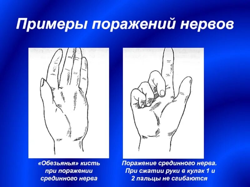 Поражение нервов руки. Поражение срединного нерва Обезьянья кисть. Поражение срединного нерва Обезьянья лапа. Обезьянья лапа симптом поражения. Симптомы поражения срединноонерва.