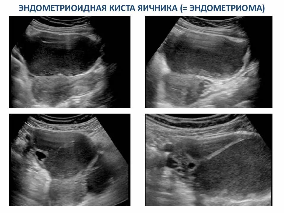 Эндометриоидная киста на УЗИ. Эндометриозные кисты яичника. Эндометриоидная киста яичников.