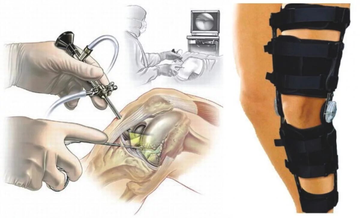 Операция на разрыв мениска артроскопия. Артроскопия ПКС коленного сустава. Операция артроскопия коленного сустава. Разрыв мениска коленного операция. Повреждения мениска коленного сустава как лечить