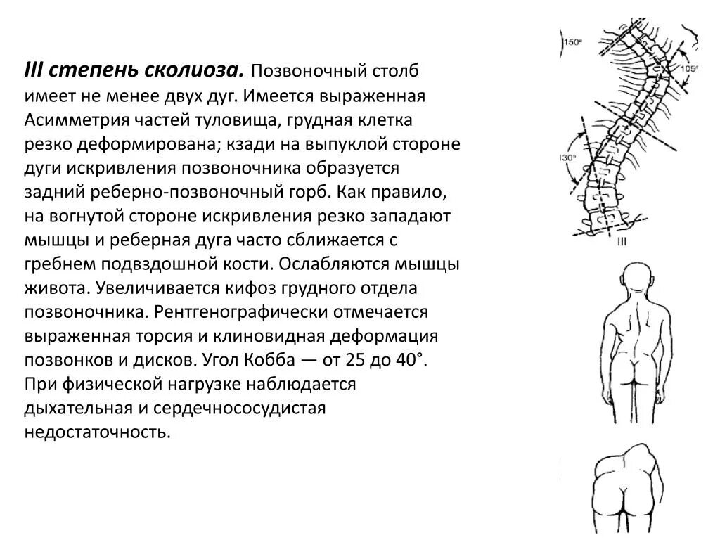 Сколиоз 3 степени угол Кобба. Сколиоз 2 степени угол искривления. Сколиоз поясничного отдела позвоночника 3ст.. Сколиотическая дуга позвоночника. Сколиоз 2 степени это