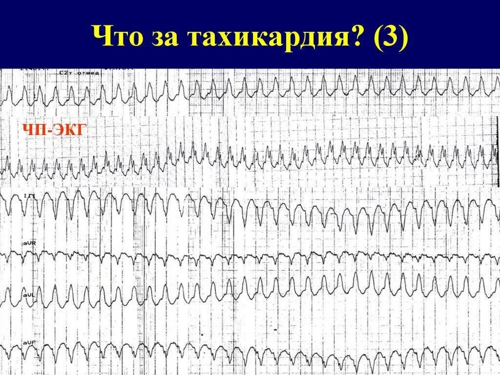 Берут ли в армию с тахикардией. Виды тахикардии. Учащенное сердцебиение. Синусовая тахикардия на экг у ребенка 7 лет. Синусовая тахикардия аускультация.