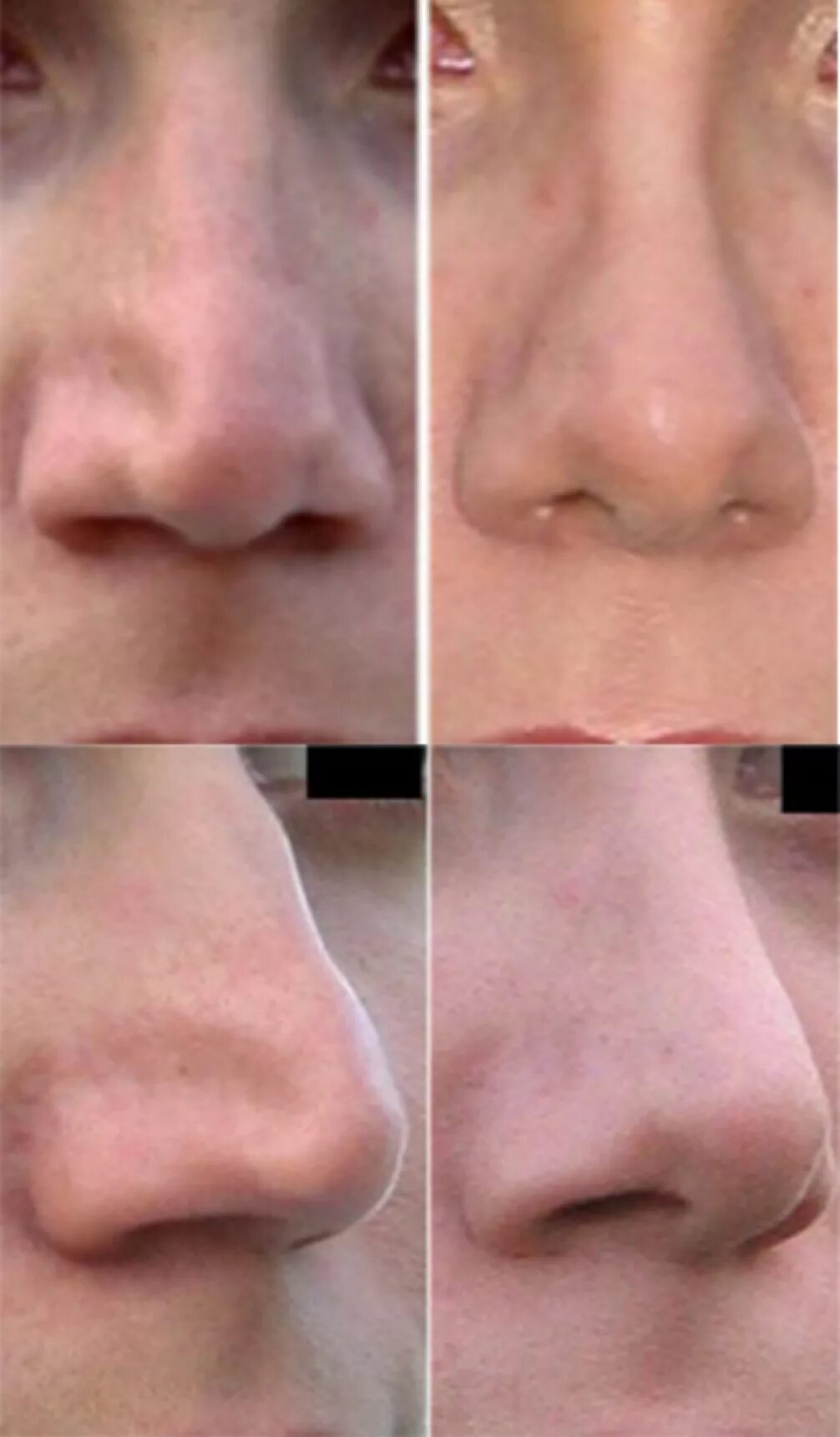 Дипроспан ринопластика. Ринопластика сужение носа. Пластика носа дипроспаном. Уколы дипроспана в нос до и после.