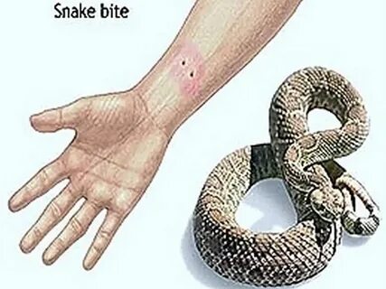 Snake bit