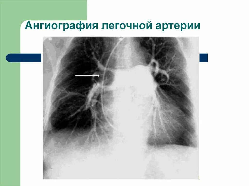 Ангиопульмонография Тэла. Тромбоэмболия пневмония кт. Тромбоэмболия ветвей легочной артерии рентген. Оторвался тромб в легких