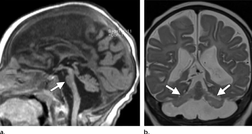 Гипоплазия червя. Гипоплазия червя мозжечка мрт. ВПР ЦНС гипоплазия червя мозжечка. Гипоплазия червя мозжечка кт. Кортикальная дисплазия мозжечка мрт.