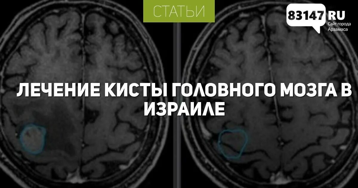 Киста головного мозга армия. Киста головного мозга препарат. Лечится ли киста в головном мозге. Таблетки от кисты в голове.