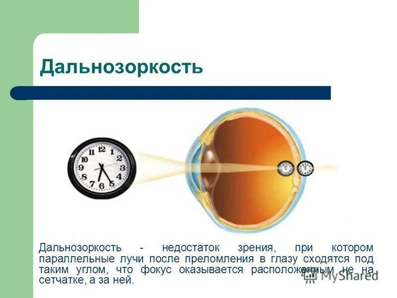 Близорукость это плюс или минус очки. Зрение дальнозоркость. Дальнозоркость это плюс или минус. Минус это близорукость или дальнозоркость. Что человек видит при дальнозоркости.