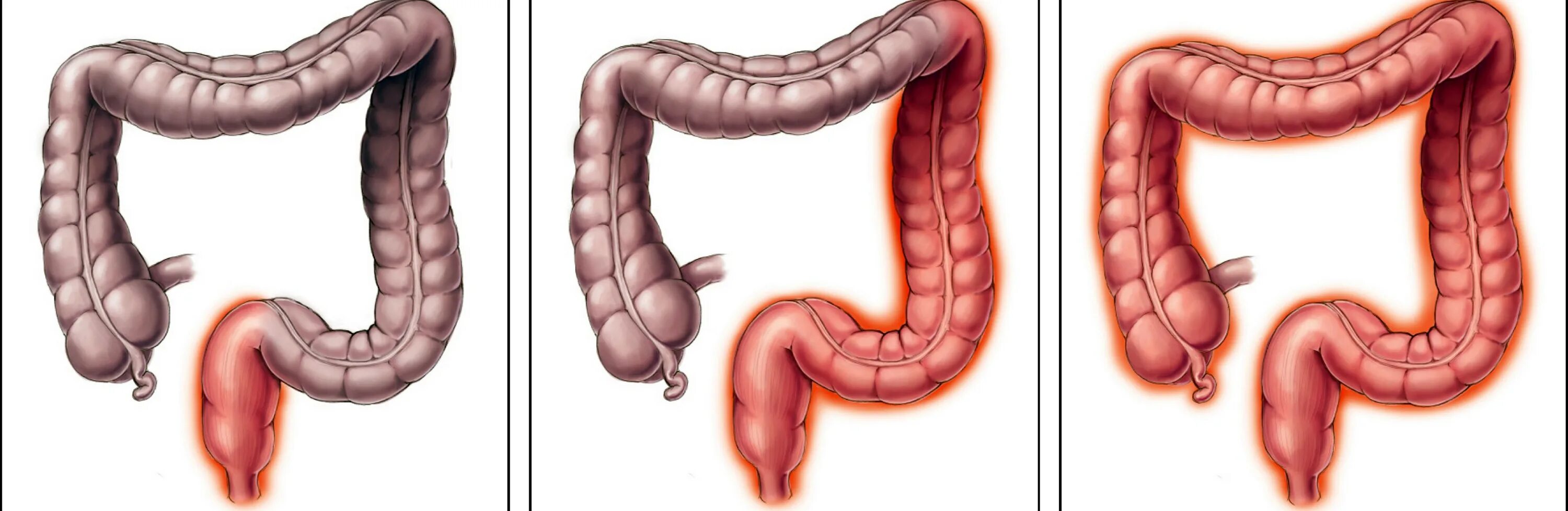 Колика при колите. Язвенный колит толстой кишки. Что такое язвенный колит Толстого кишечника. Няк поражение Толстого кишечника. Язвенный колит прямой кишки.