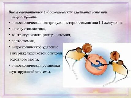 Гидроцефалия мкб