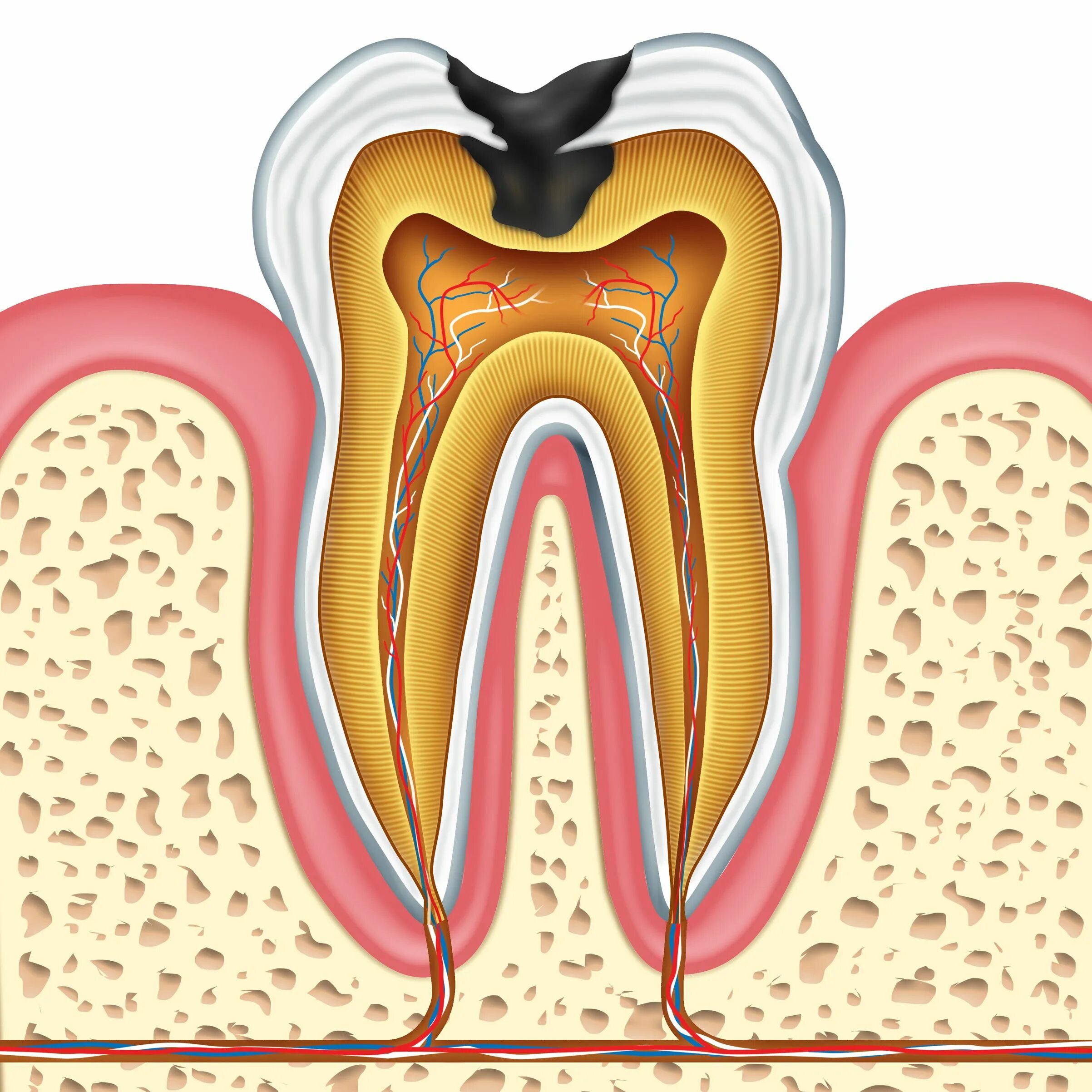 Root canal. Многокорневой пульпит. Кариес пульпит периодонтит.