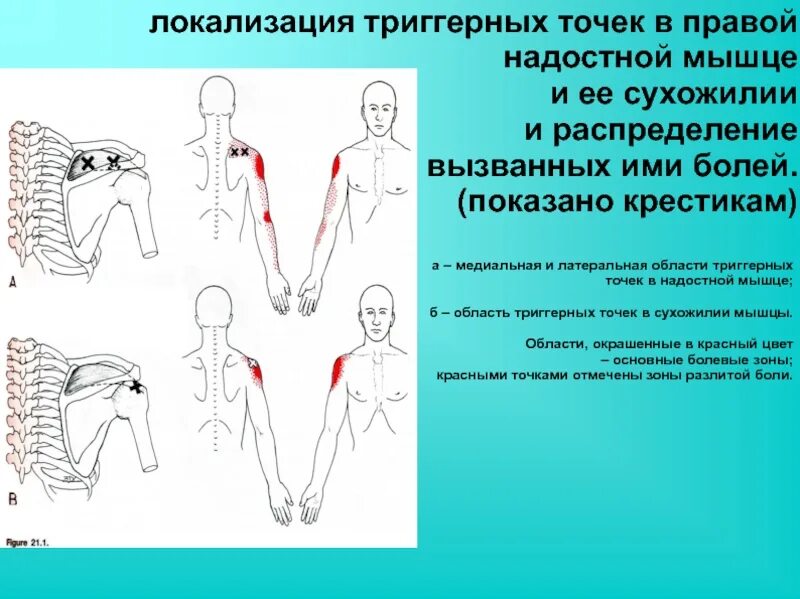 Надостная мышца триггерные точки. Надостная мышца локализация боли. Триггерные точки надостной мышцы плеча. Надостная мышца иррадиация боли. Триггерные точки это простыми словами