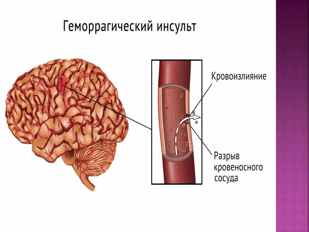 Ишемическом инсульте кровоизлияние