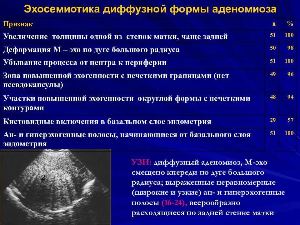 При аденомиозе можно забеременеть. Аденомиоз 1 степени диффузная форма. Критерии аденомиоза на УЗИ. Диффузный эндометриоз матки УЗИ. Диффузная форма аденомиоза УЗИ.