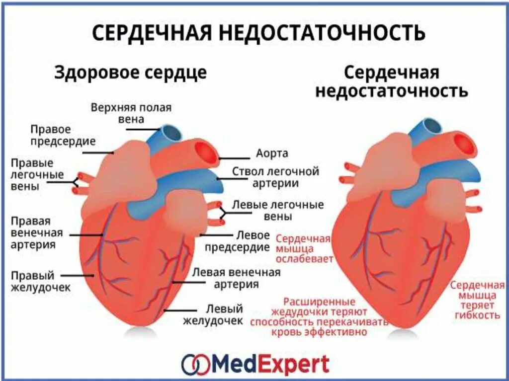 Большая сердечная недостаточность