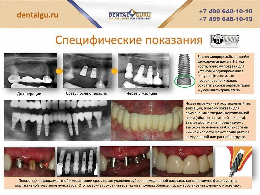 Имплантация зубов в Москве - цена от 20 990 руб (имплант + установка) в "Центре 