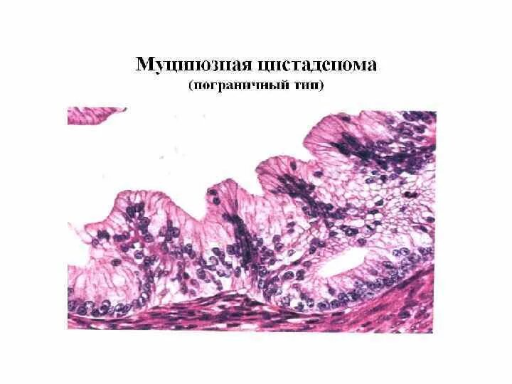 Экспансивный рост это. Экзофитный и эндофитный рост опухоли. Экзофитный экспансивный рост. Экзофитный рост опухоли кишечника.