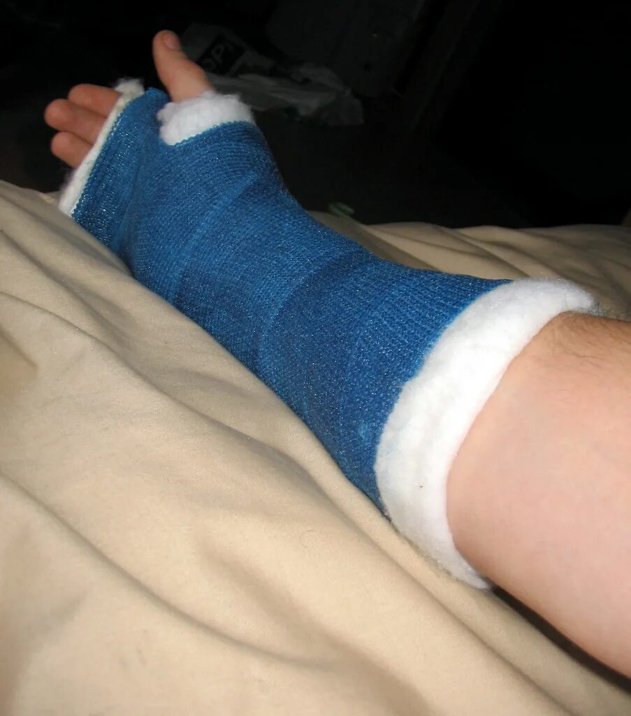 This is what happens when you fall off your mountain bike.. Flickr