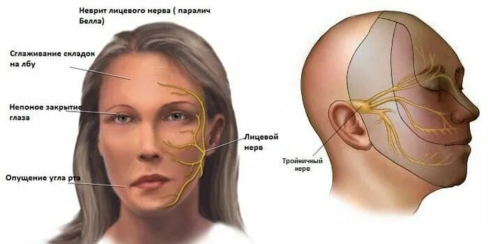 Воспаление тройничного лицевого нерва симптомы. Нерв тройничный лицевой воспалился. Лицевой нерв и тройничный нерв. Неврит лицевого нерва и тройничного нерва.