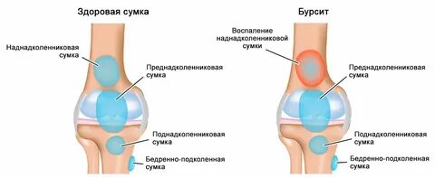 Выпот коленного сустава что это