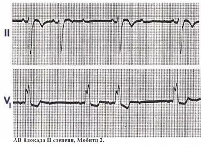 A-V блокада 2 степени ЭКГ. Атриовентрикулярная блокада 2 степени на ЭКГ. АВ блокада 1 ст. Блокада Мобитц 1 на ЭКГ. Av блок