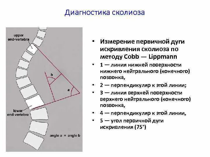 Сколиоз по коббу степени рентген. Угол сколиоза по чаклину рентген. Метод Кобба сколиоз степени. Сколиотическая дуга метод Кобба степени. Угол кобба