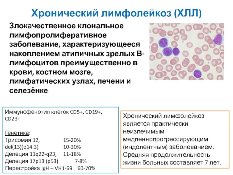 В -лимфоциты хронический лимфолейкоз. Хронический лимфоцитарный лейкоз анализ крови. Лимфатические узлы при хронический лимфолейкоз. Показатели лимфоцитов при лимфолейкозе. B хронический лимфолейкоз