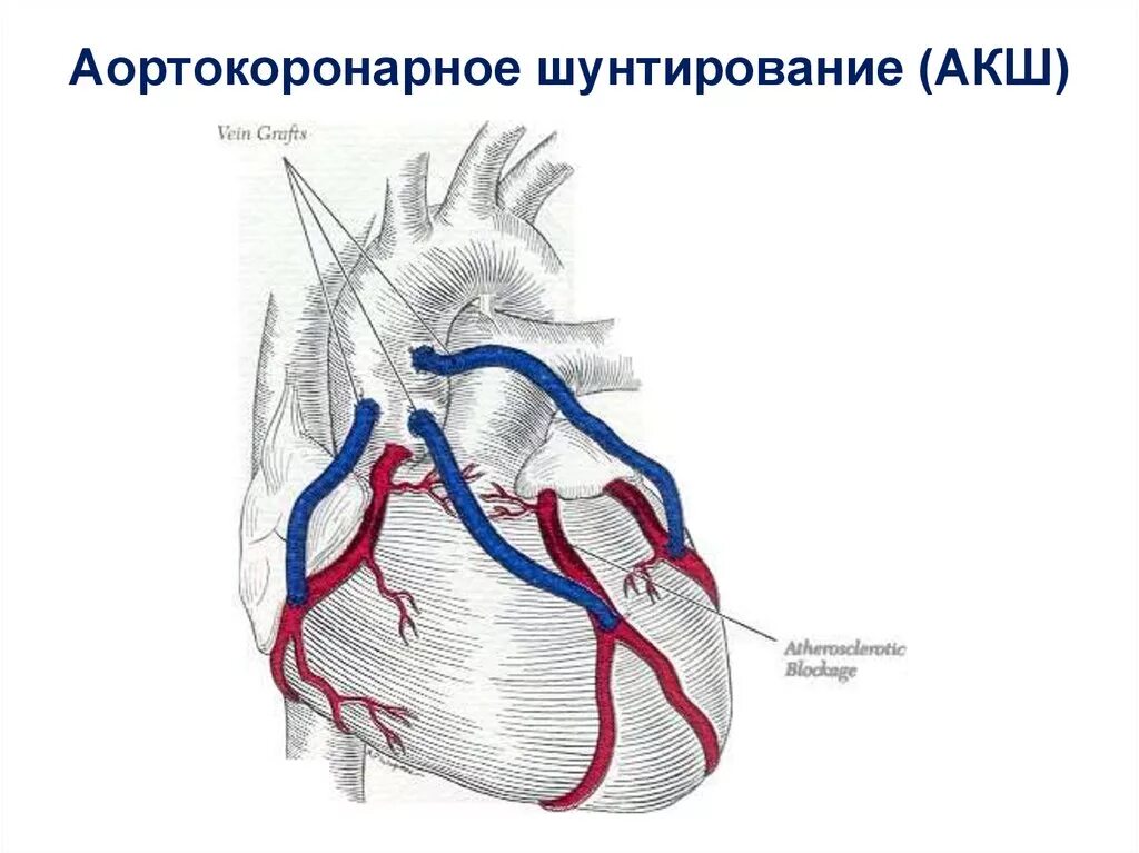 Коронарное шунтирование сосудов. Аортокоронарное шунтирование схема. Маммарокоронарное шунтирование схема. Операция шунтирование артерии