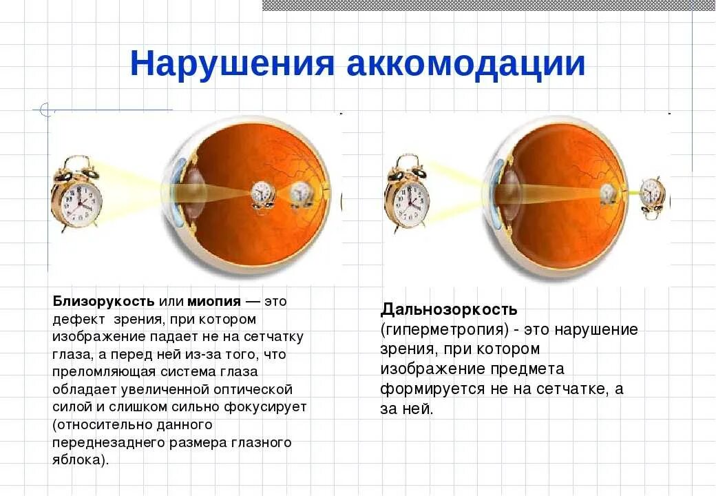 Заболевания аккомодации