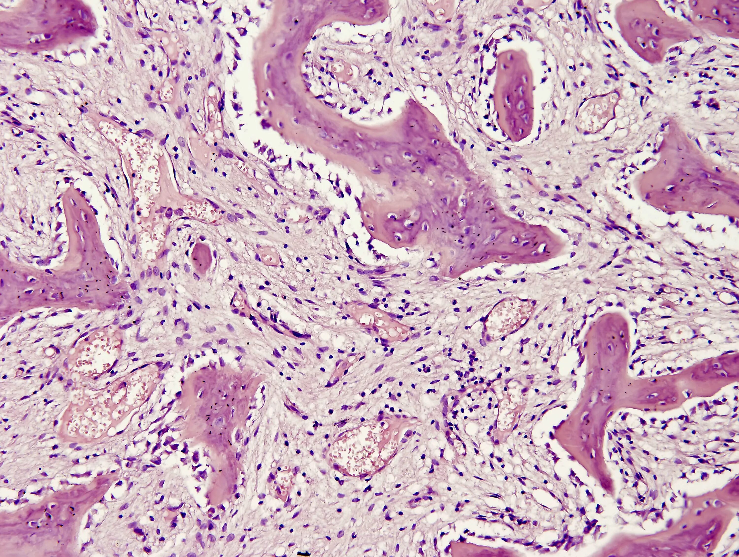 Гистология фиброзные фрагменты. Фиброаденома молочной железы гистология. Тиреоидит риделя микропрепарат. Первичный билиарный цирроз гистология. Доброкачественная фиброзная гистиоцитома гистология.