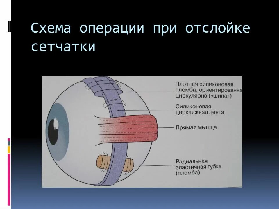Пломбирование сетчатки глаза. Пломба при отслойке сетчатки. отслойка сетчатки экстрасклеральное пломбирование. склеральное пломбирование сетчатки глаза. пломба при отслойке сетчатки глаза.