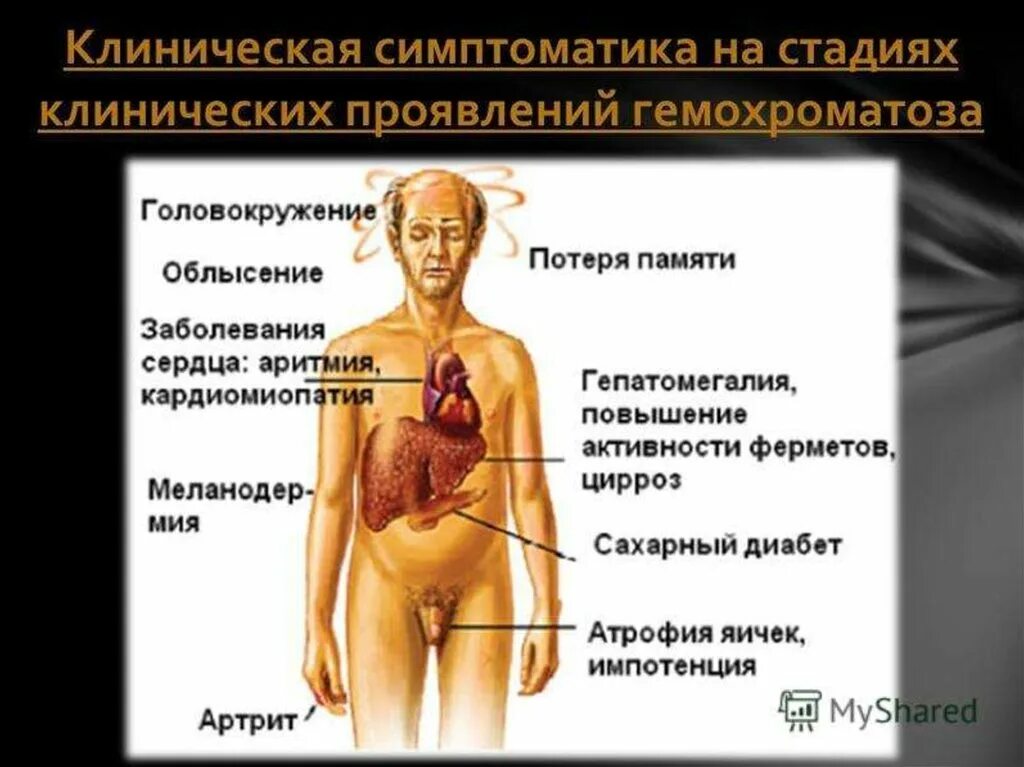 Симптомы печени как проявляется. Симптомы церозапечент. Внешние проявления цирроза печени. Внешние признаки церроз печени. Внешний вид больного циррозом.