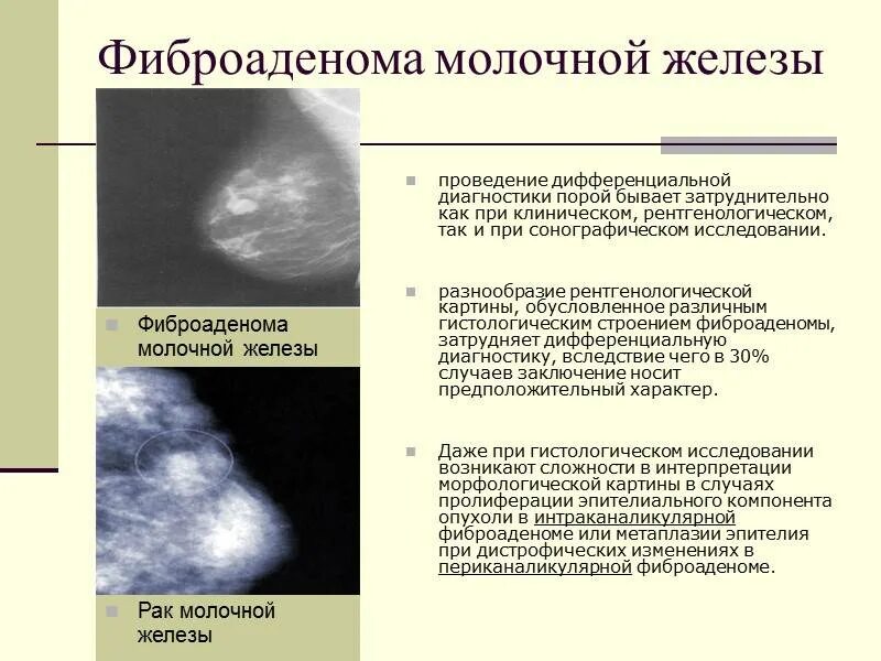 Что означает фиброзное изменение. Фиброаденома Узловая мастопатия молочной железы. Фиброаденома молочной железы дифференциальный диагноз. Обызвествленная фиброаденома молочной железы рентген. Фиброзно-кистозная мастопатия молочных желез на маммографии.