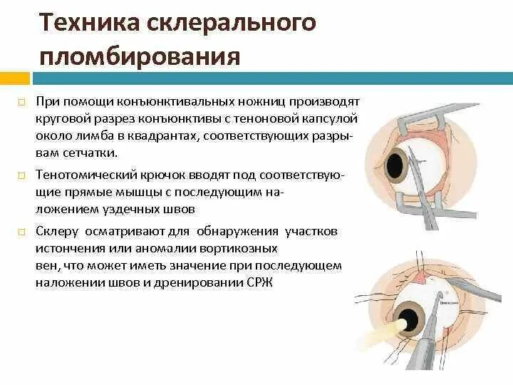 Отслойка сетчатки экстрасклеральное пломбирование. Отслойка сетчатки биомикроскопия. Экстрасклеральное пломбирование сетчатки глаза. Склеральное пломбирование сетчатки. Сделайте кольцевой надрез