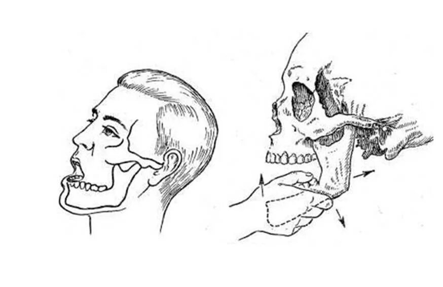 Схему вправления вывиха нижней челюсти. Вывих височно-нижнечелюстного сочленения (вывих нижней челюсти).