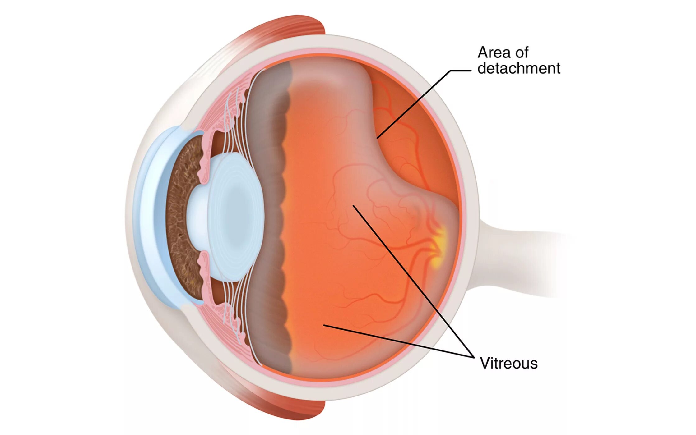 Отслойка стекловидного тела. Задняя отслойка стекловидного тела глаза симптомы. Отслоение гиалоидной мембраны глаза. Задняя гиалоидная мембрана стекловидного тела.