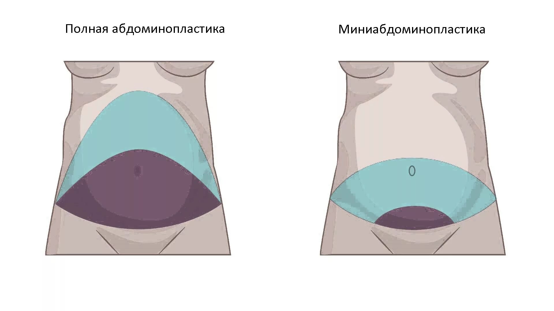 Схема абдоминопластики. Абдоминопластика живота схема. Мини абдоминопластика. Мини абломино. Операция на животе называется