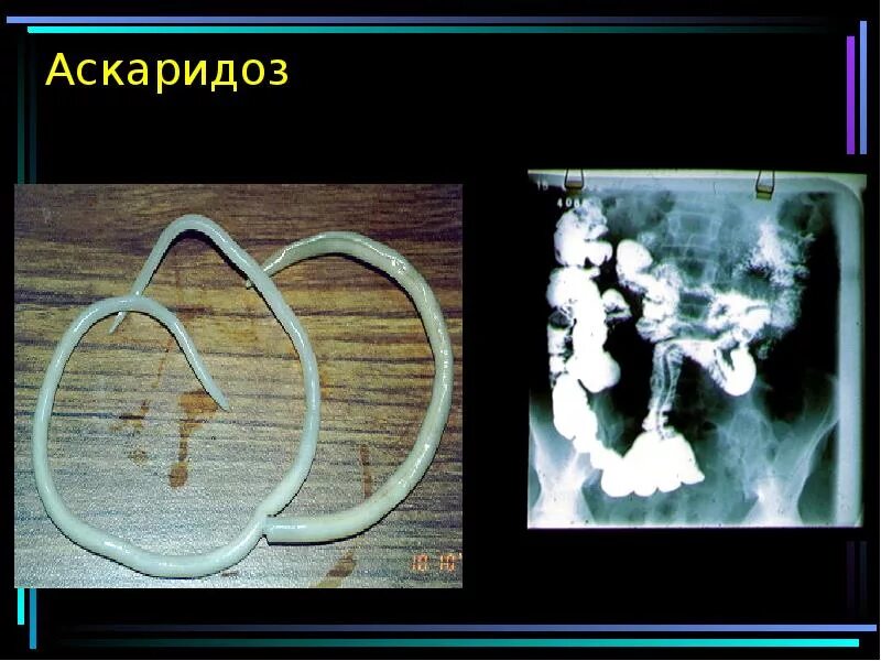 Какой вред могут причинять взрослые аскариды организму. Аскаридоз,анкилостомидоз,некатороз,энтеробиоз. Аскаридоз биогельминтоз. Заболевание аскаридоз. Аскаридоз исследование.