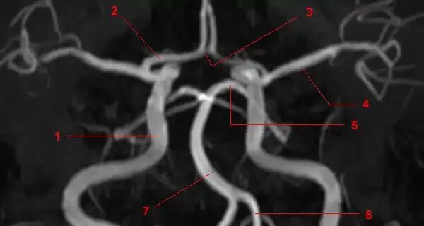 Виллизиев круг аневризмы. Виллизиев круг анатомия на кт. Виллизиев круг сегменты мрт. Виллизиев круг на кт ангиографии. Гипоплазия правой артерии мозга