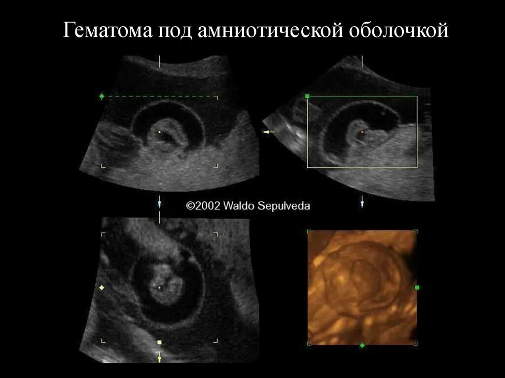 Отслойка на 6 неделе беременности УЗИ. УЗИ беременность 6 недель с гематомой. Гематома при беременности на ранних УЗИ. Гематома 8 неделя