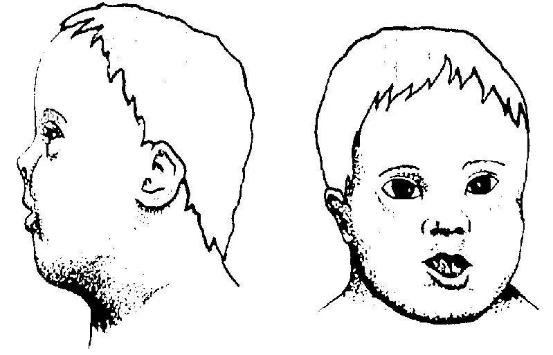 Форма головы у детей с синдромом Дауна. Переносица у детей с синдромом Дауна. Плоское лицо. Лицо ребенка с синдромом Дауна. Голова дауна