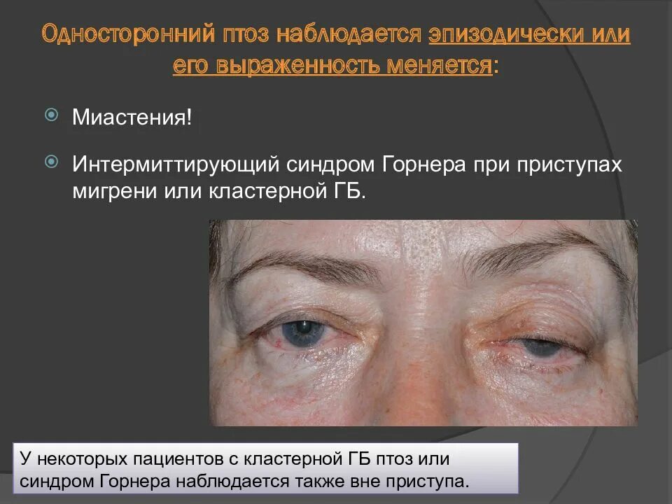 Синдром горнера это