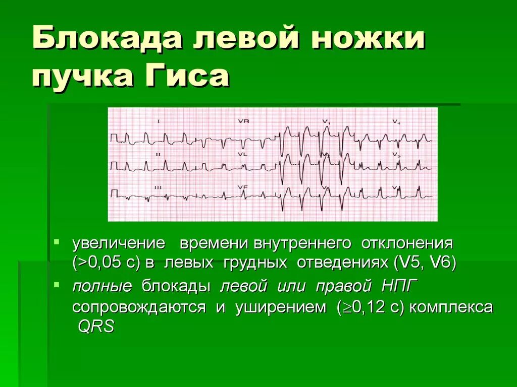 Признаки блокада левой ножки. ЭКГ при блокаде левой ножки пучка Гиса. ЭКГ при блокадах ножки пучка Гиса. ЭКГ критерии блокады левой ножки пучка Гиса. ЭКГ критерии полной блокады левой ножки пучка Гиса.