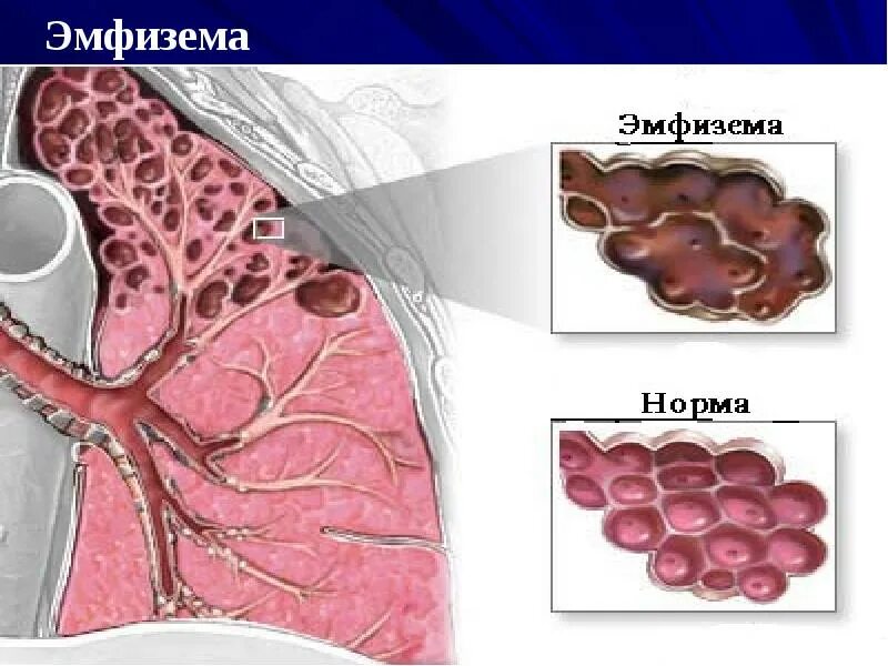 Увеличенные легкие причины. Увеличенные легкие причины. Бочкообразная грудная клетка эмфизема. Эмфизема буллезная форма. Увеличенные легкие причины.