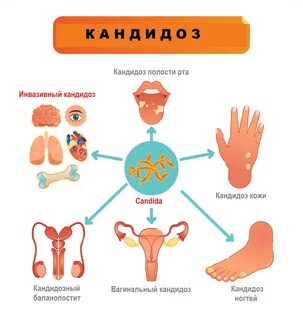 Молочница у мужчин причины возникновения