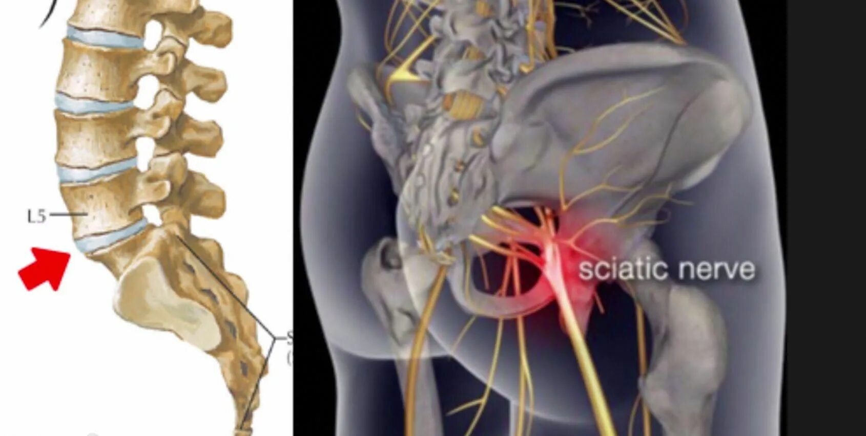 Седалищный нерв (sciatic nerve)? 011. Седалищный нерв схема расположения. Защемление крестцового нерва. Пояснично-крестцовый радикулит. Можно ли греть при защемлении