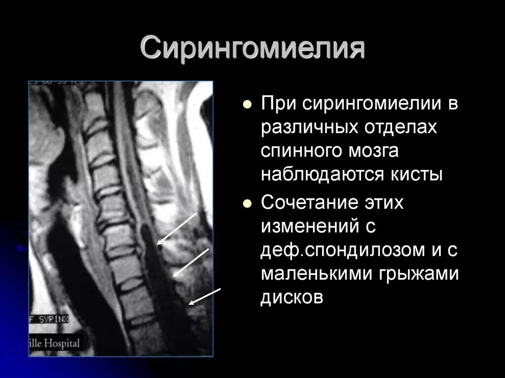 Болезнь позвоночника сирингомиелия. Сирингомиелия и Сирингобульбия. Сирингомиелия поясничного отдела. Сирингомиелическая киста спинного мозга мрт.