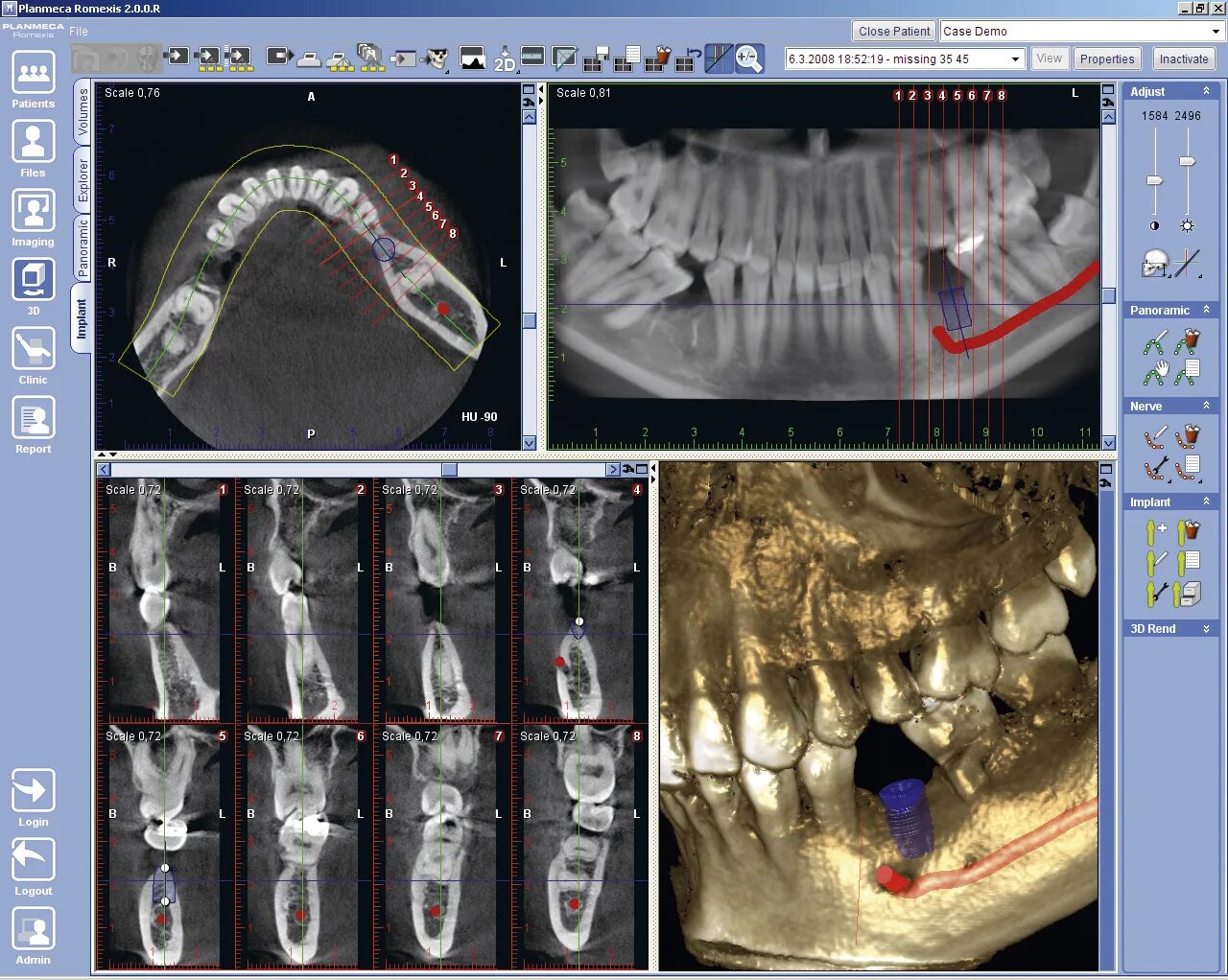 Имплант и мрт можно ли. Конусно-лучевая компьютерная томография ( КЛКТ) зубов. Planmeca кт. 3д конусно-лучевая компьютерная томография.