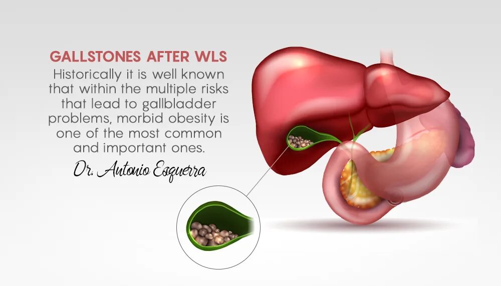 Жкб печени. Желчнокаменная и мочекаменная болезни. Желчнокаменная болезнь. Желчнокаменная болезнь 3д.